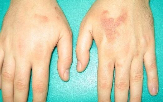 Pain in the joints of the hands can be symptoms of parasites