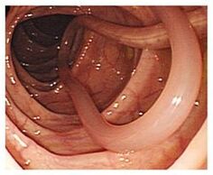 Parasites in the human body