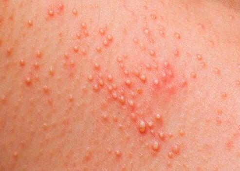 When the body is infected with parasites, a skin allergy occurs