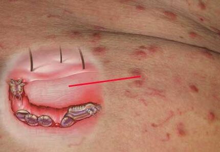 Scabies mite under the human skin