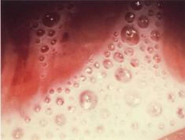 Bladder discharge with protozoal parasites