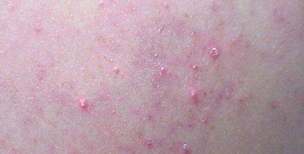 Skin rashes can be a sign of helminthiasis